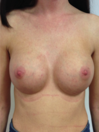 Brustvergrösserung (Runde Implantate) Before & After Patient #1199
