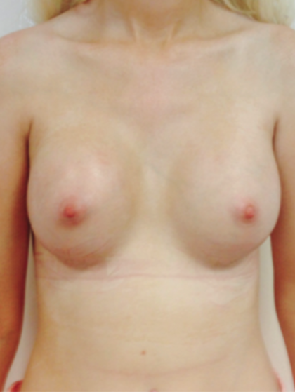 Brustvergrösserung (Runde Implantate) Before & After Patient #1194