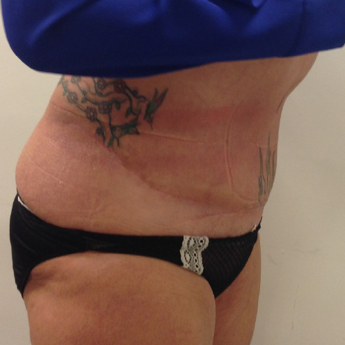 Bauchdeckenstraffung Before & After Patient #1081