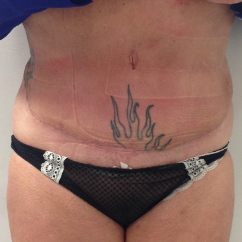 Bauchdeckenstraffung Before & After Patient #1081