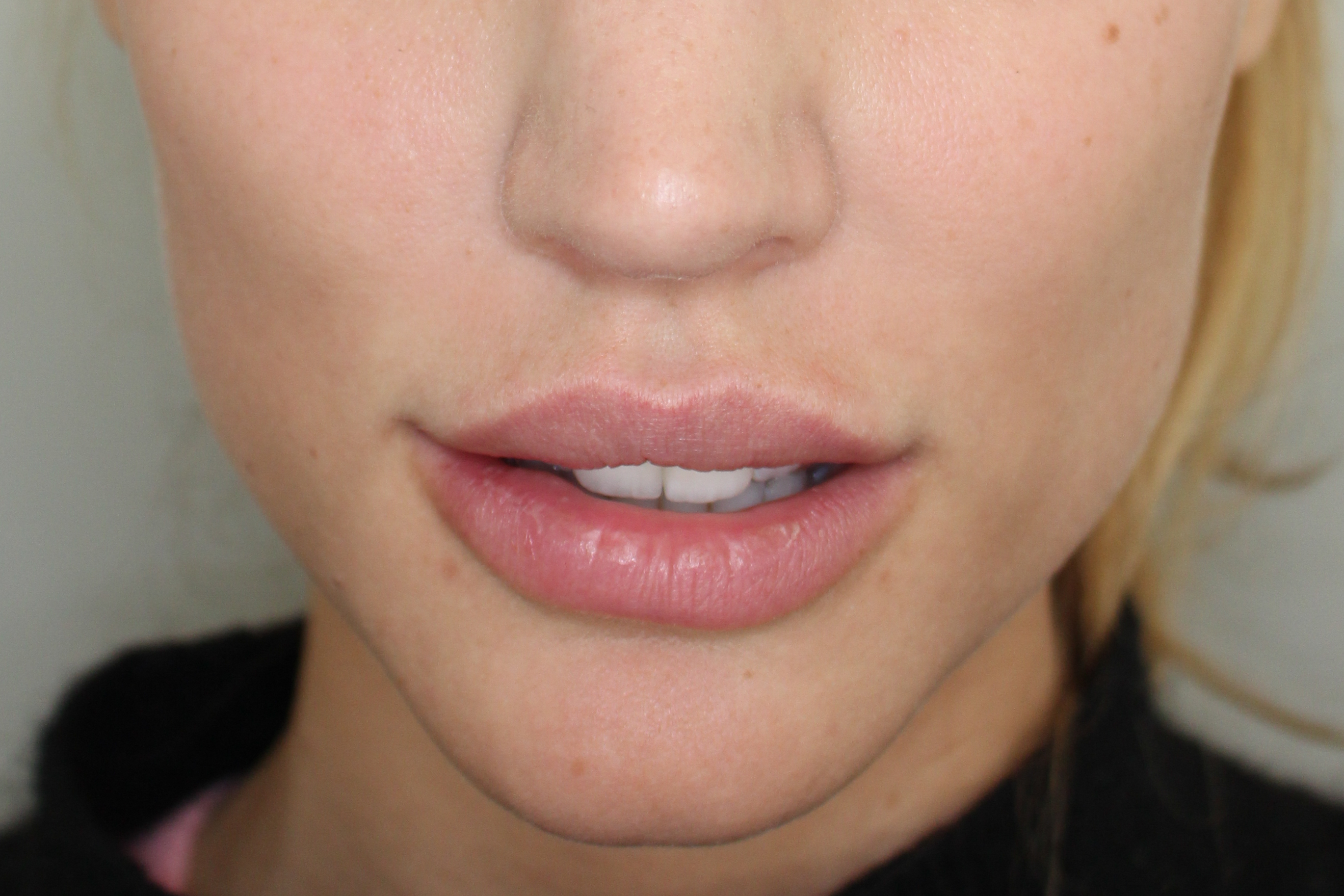 Lippenmodellierung Before & After Patient #1228