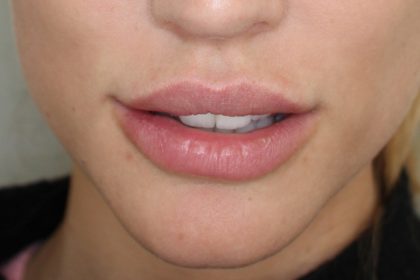 Lippenmodellierung Before & After Patient #1228