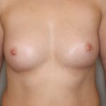 Brustvergrösserung (Eigenfetttransfer) Before & After Patient #1176