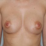 Brustvergrösserung (Eigenfetttransfer) Before & After Patient #1170