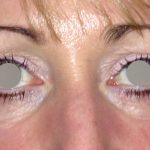 Augenlidstraffung Before & After Patient #1100