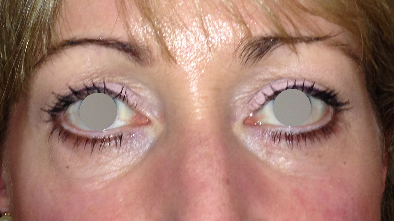 Augenlidstraffung Before & After Patient #1100
