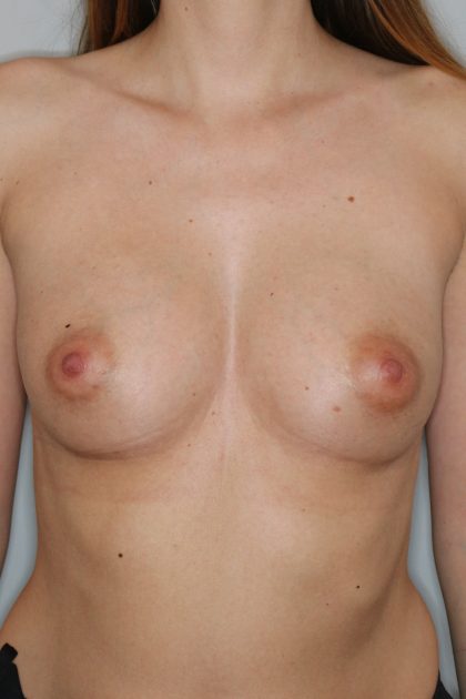 Brustvergrösserung (Eigenfetttransfer) Before & After Patient #1170