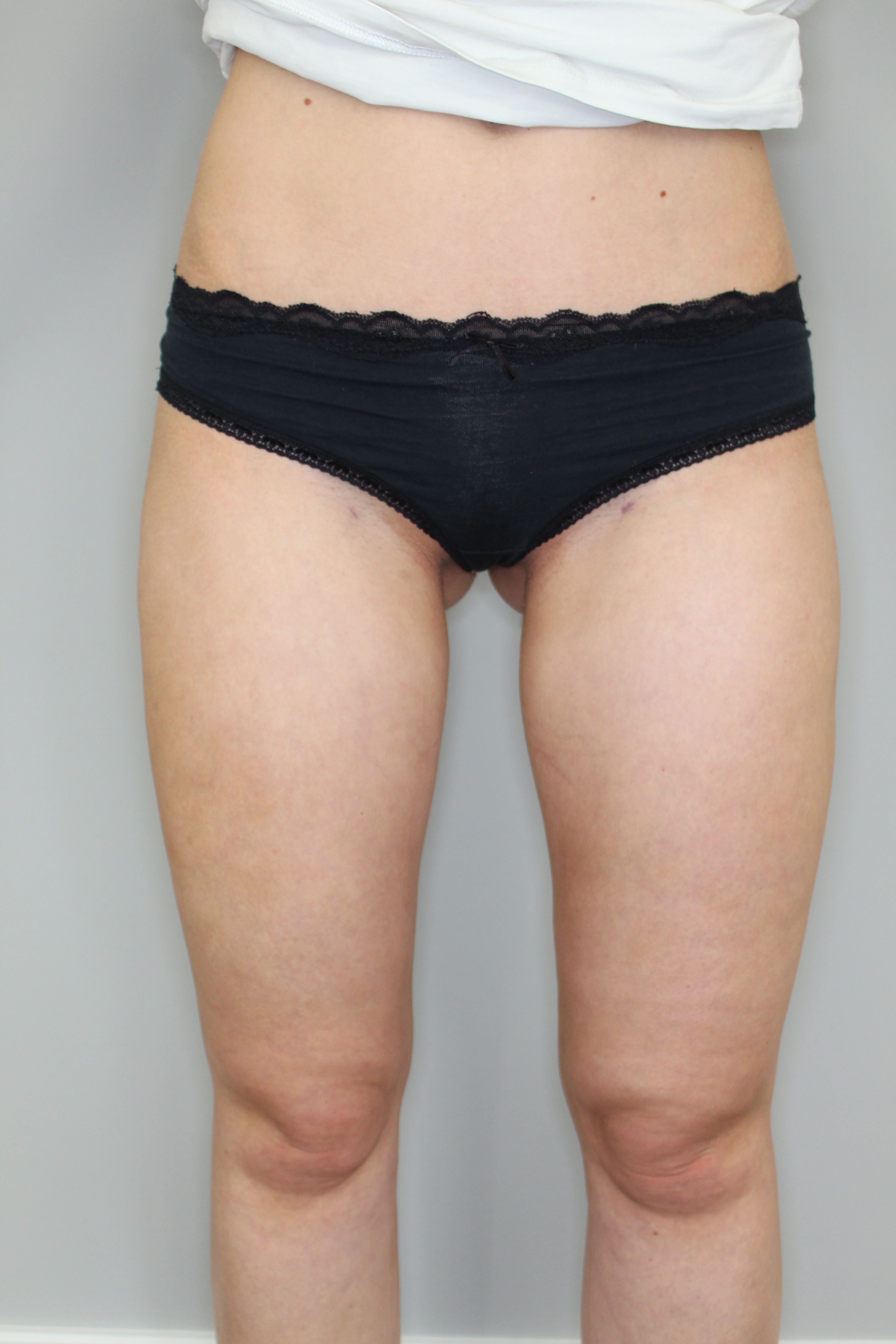 Fettabsaugung Before & After Patient #1241