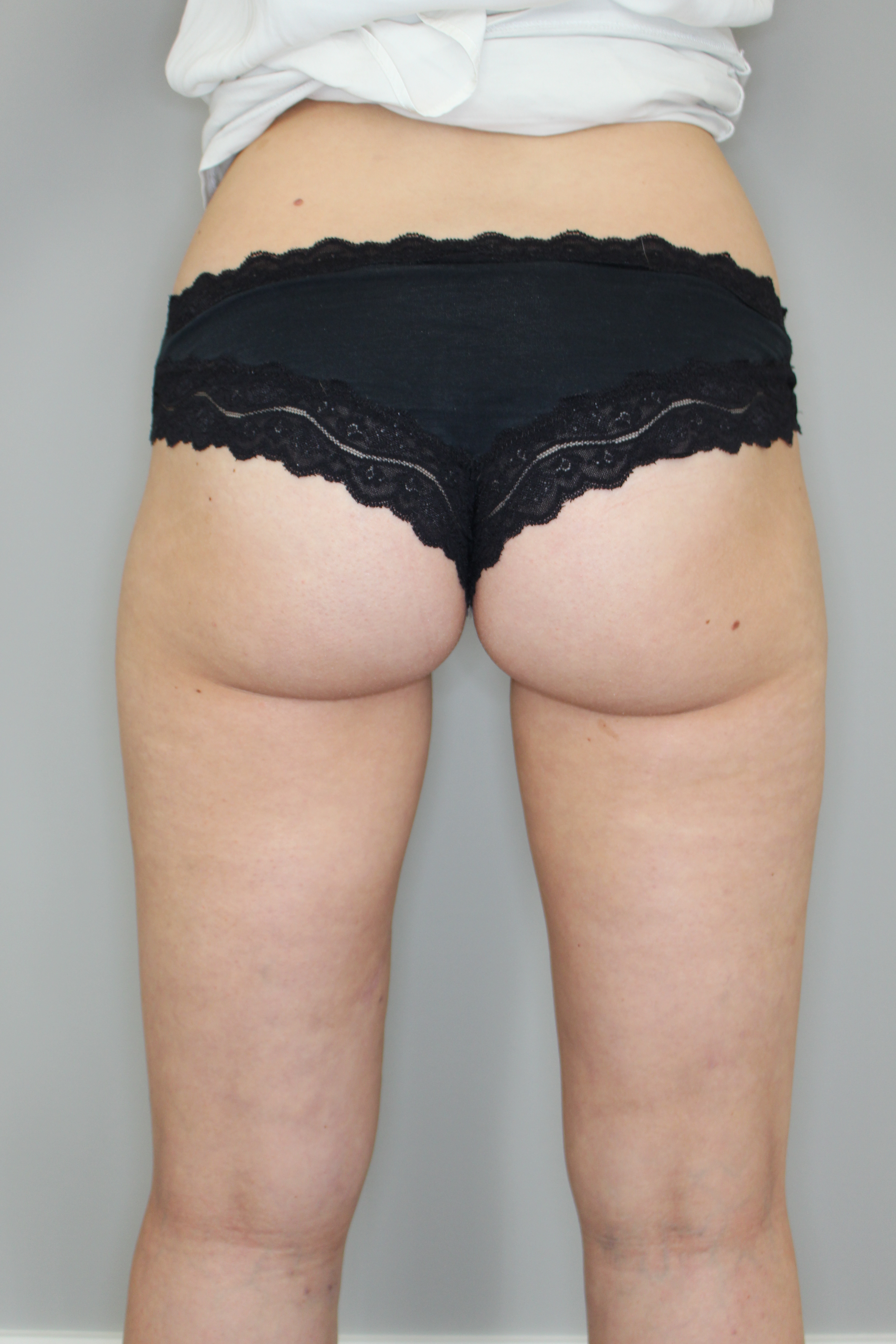 Fettabsaugung Before & After Patient #1241