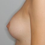 Brustvergrösserung (Anatomische Implantate) Before & After Patient #1135