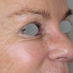 Augenlidstraffung Before & After Patient #1107