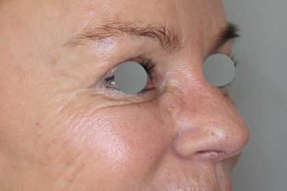 Augenlidstraffung Before & After Patient #1107