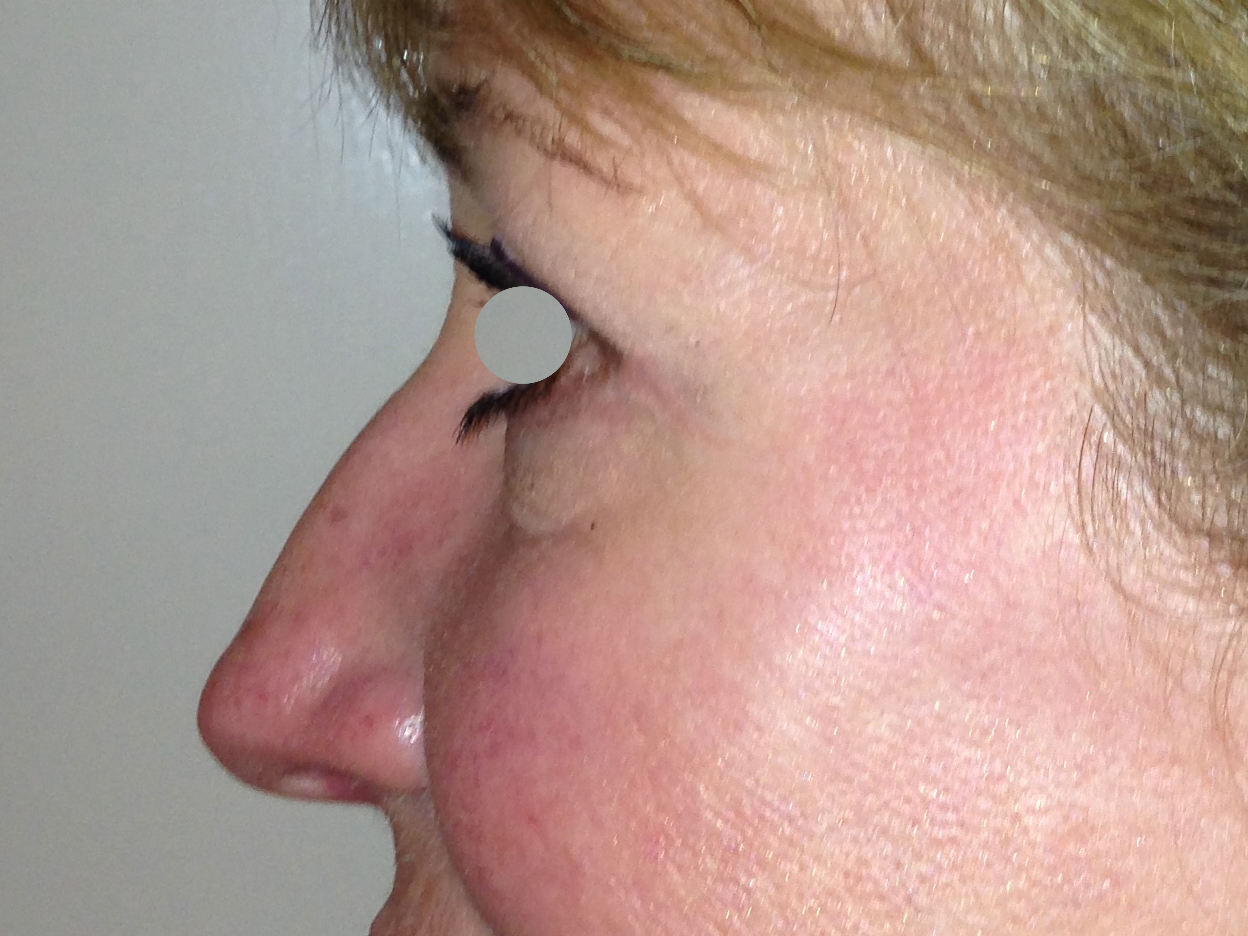 Augenlidstraffung Before & After Patient #1100