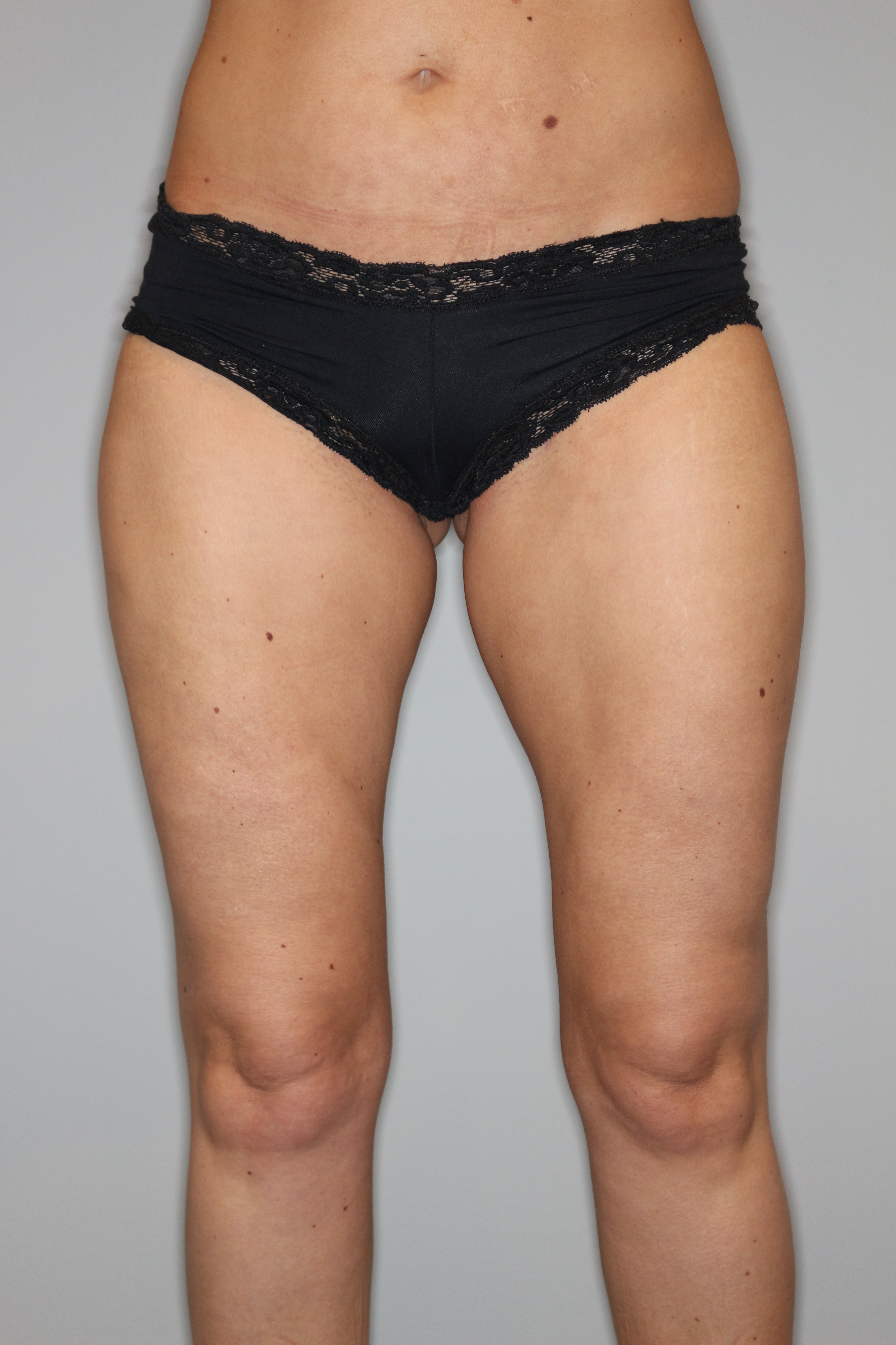 Fettabsaugung Before & After Patient #1236