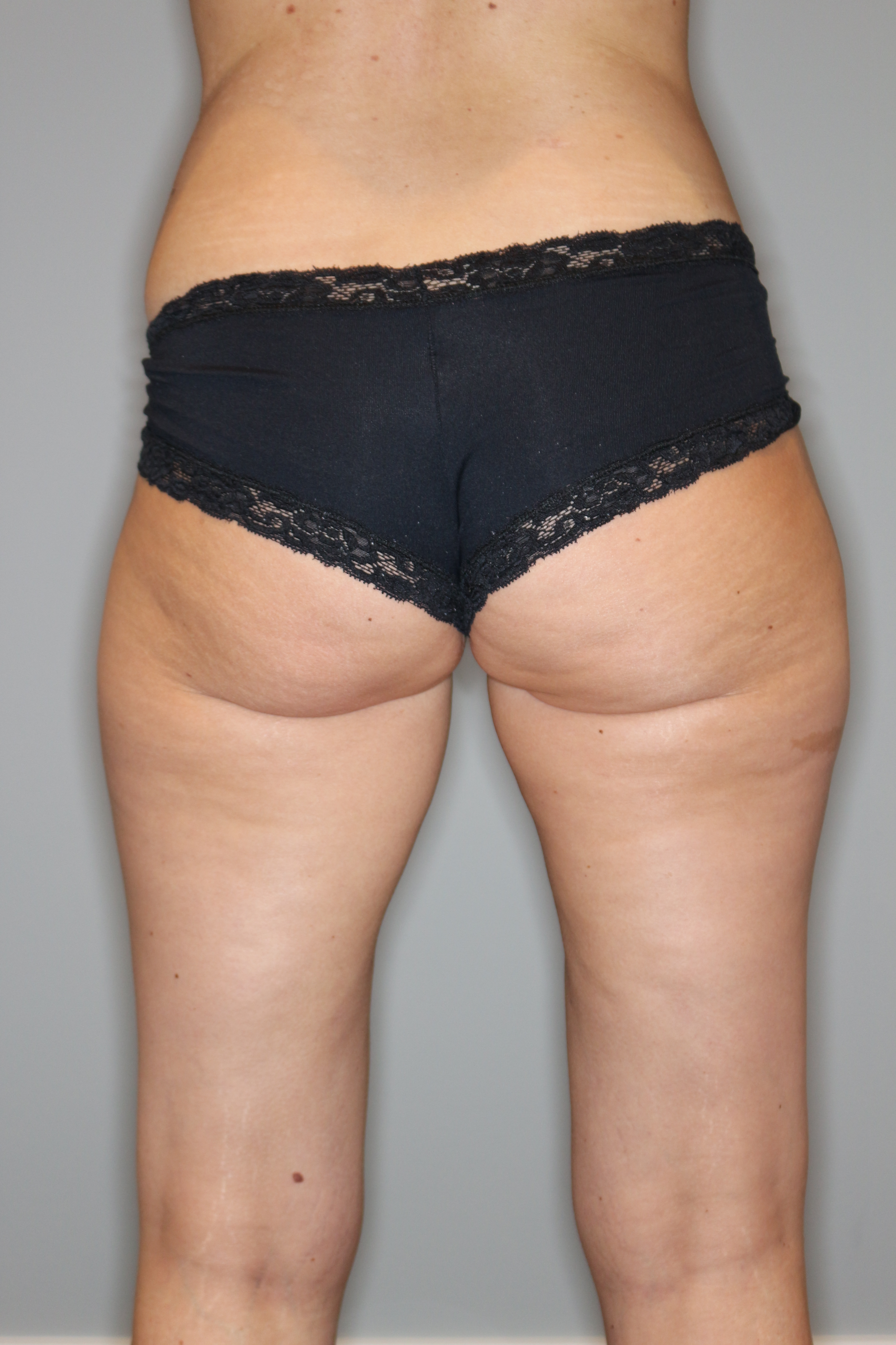 Fettabsaugung Before & After Patient #1236