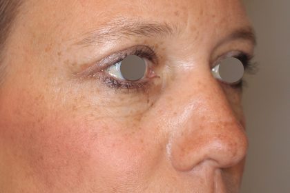 Augenlidstraffung Before & After Patient #1114