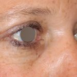 Augenlidstraffung Before & After Patient #1114
