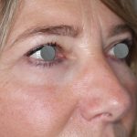 Augenlidstraffung Before & After Patient #1121