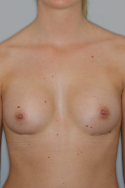 Brustvergrösserung (Anatomische Implantate) Before & After Patient #1149