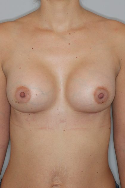 Brustvergrösserung (Anatomische Implantate) Before & After Patient #1142