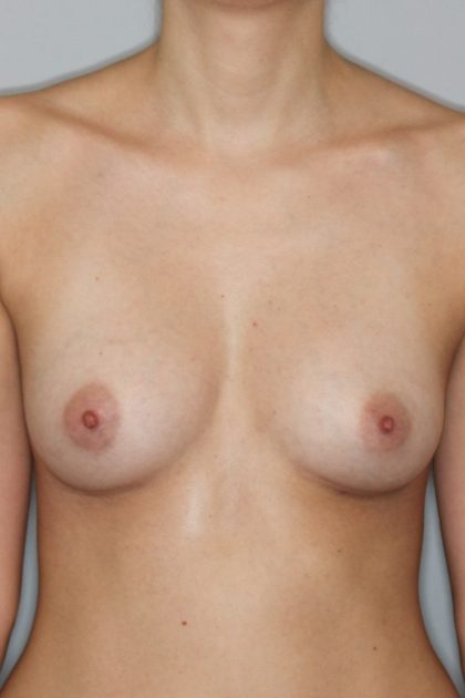 Brustvergrösserung (Eigenfetttransfer) Before & After Patient #1163