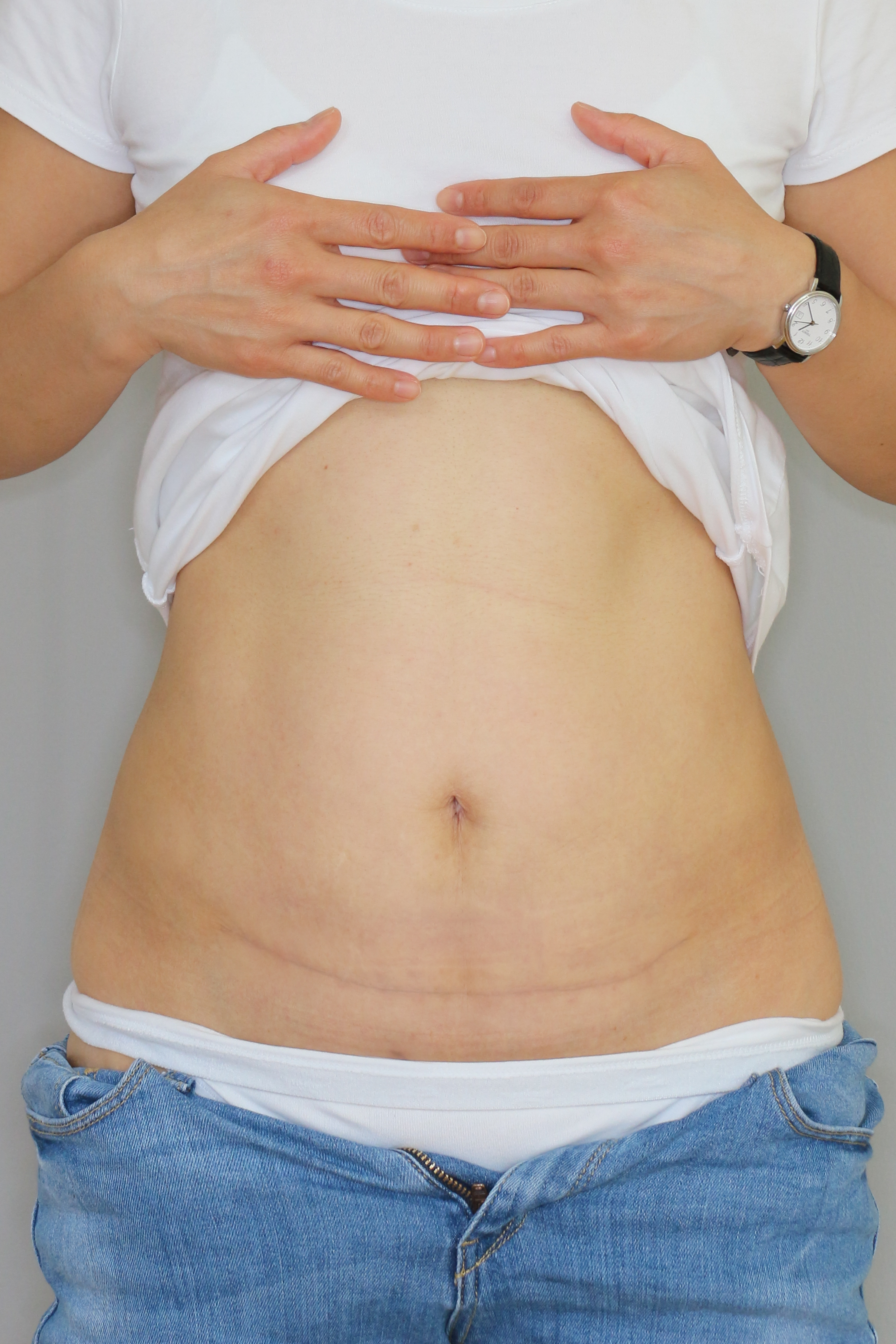 Bauchdeckenstraffung Before & After Patient #1069