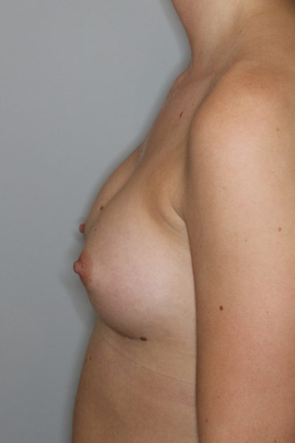 Brustvergrösserung (Anatomische Implantate) Before & After Patient #1149