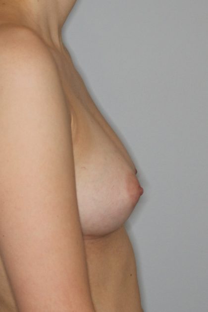 Brustvergrösserung (Eigenfetttransfer) Before & After Patient #1163