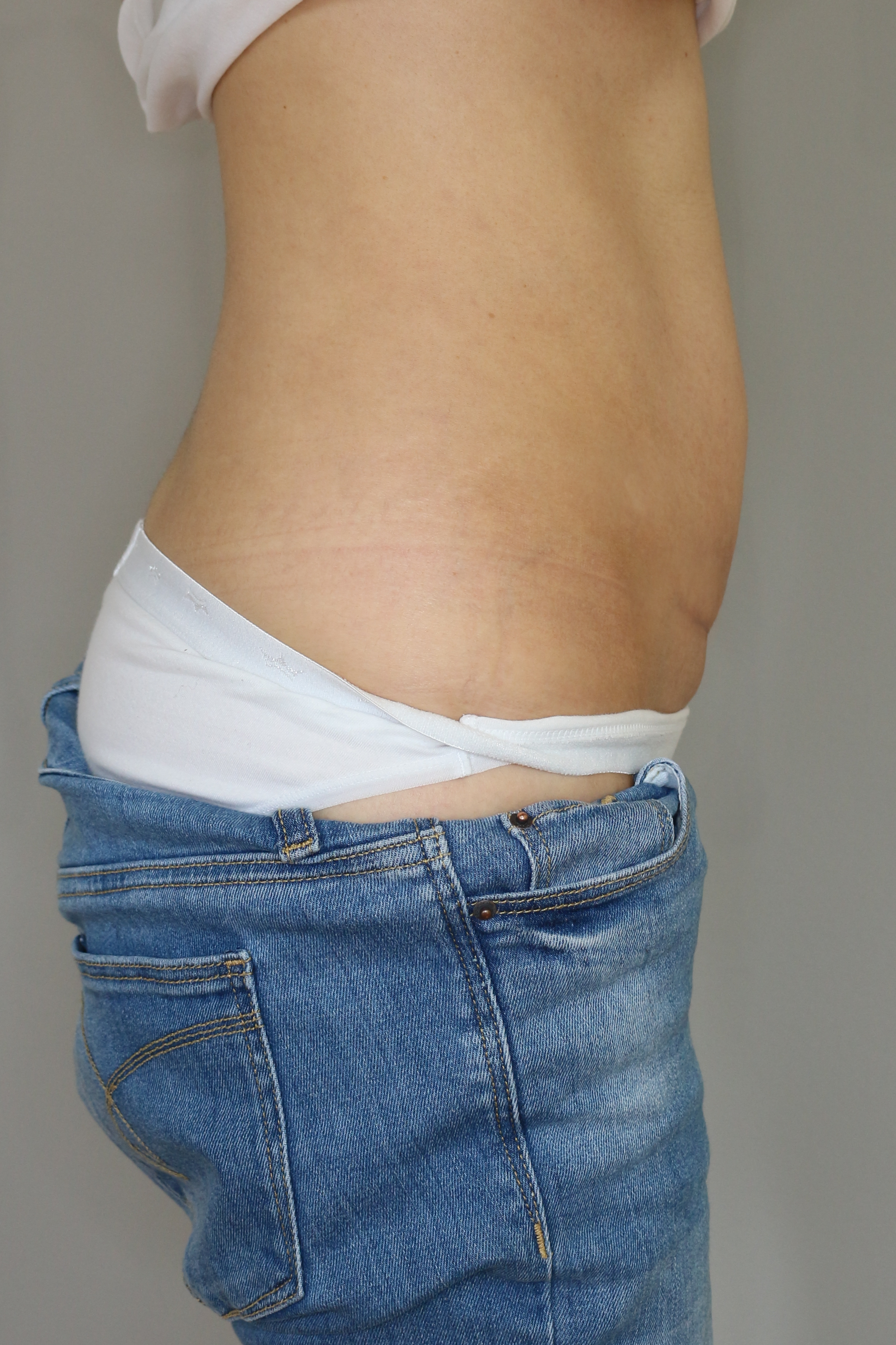 Bauchdeckenstraffung Before & After Patient #1069