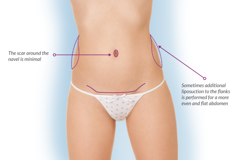 Short Scar Tummy Tuck 