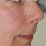 Augenlid- und Wangenmodellierung Before & After Patient #1458