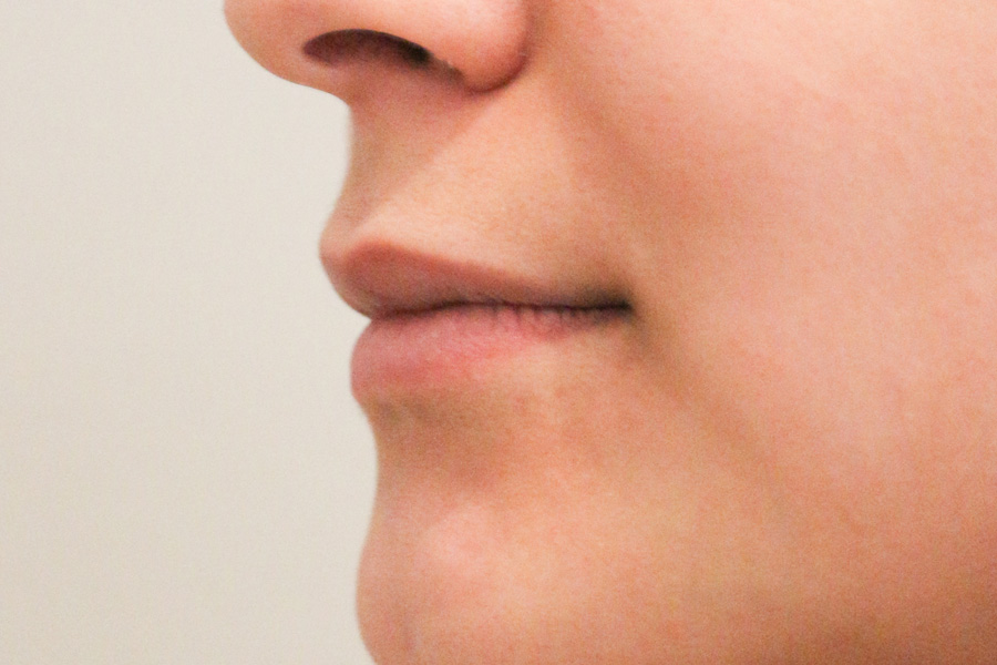 Lippenmodellierung Before & After Patient #1427