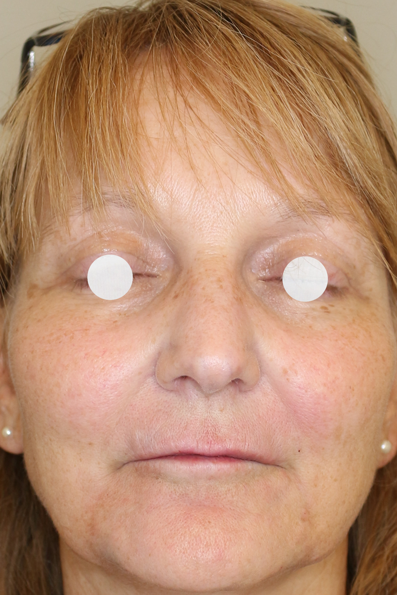 Faltenbehandlung Before & After Patient #1473
