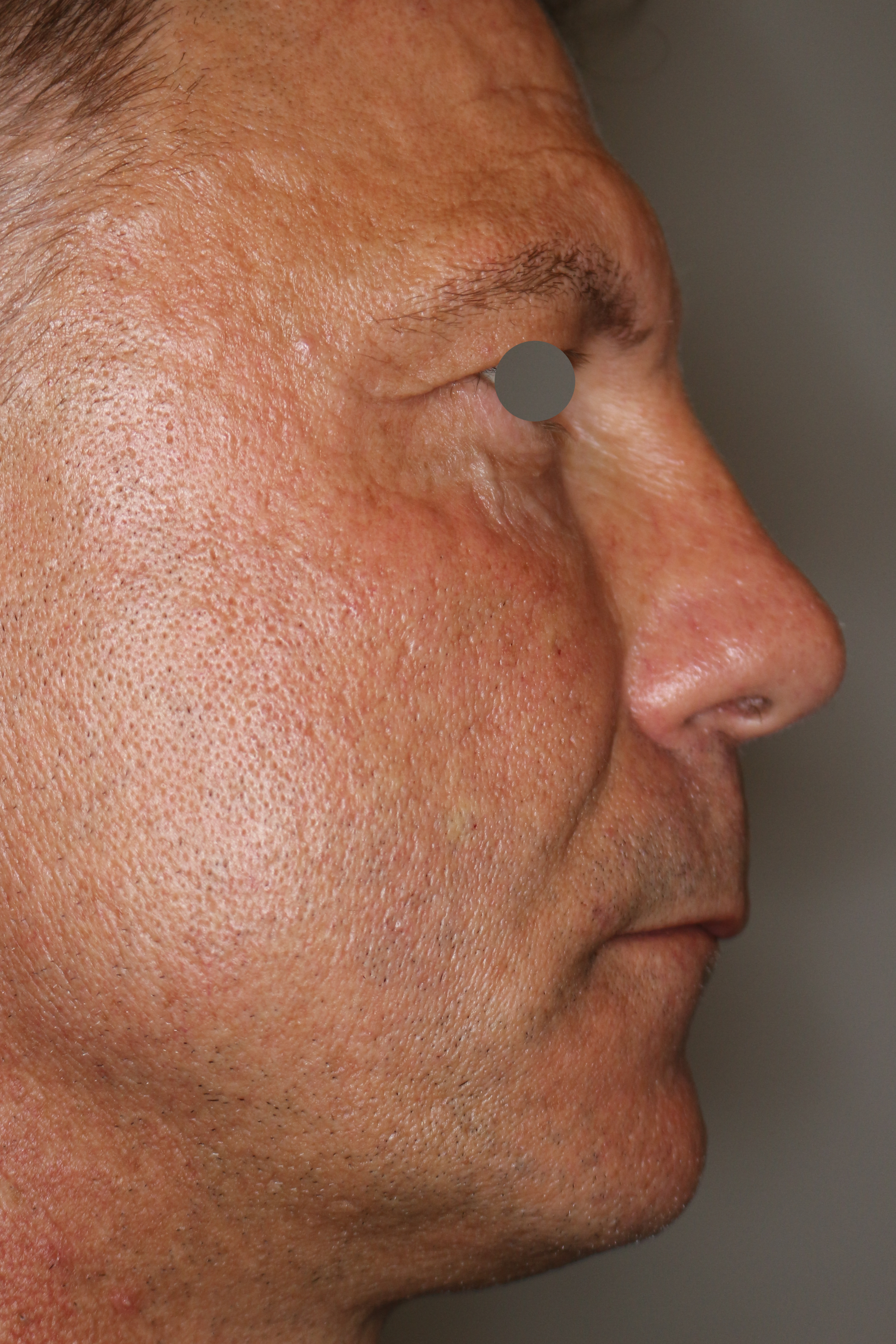 Hautunterspritzungen Before & After Patient #1409