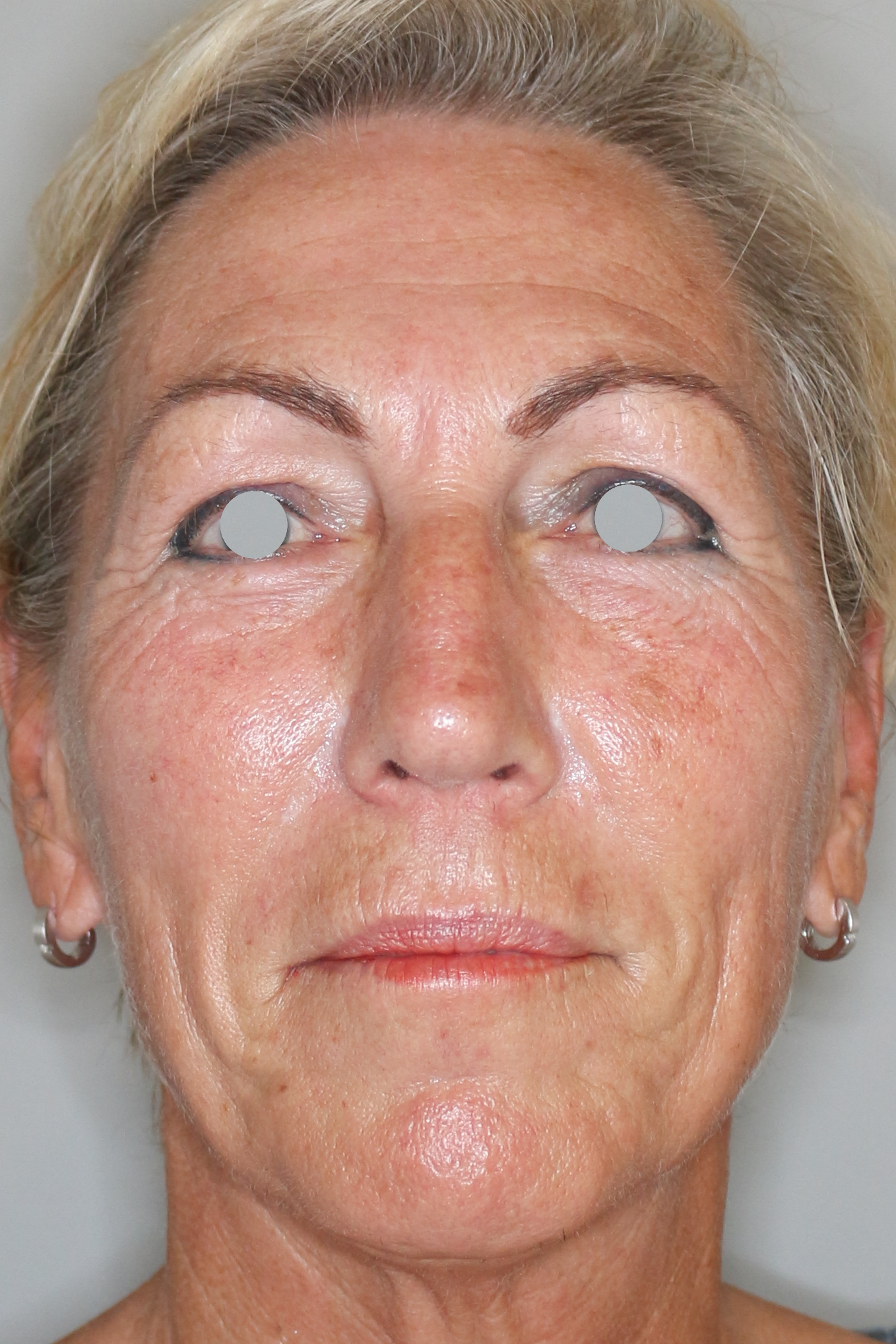 Hautunterspritzungen Before & After Patient #1397