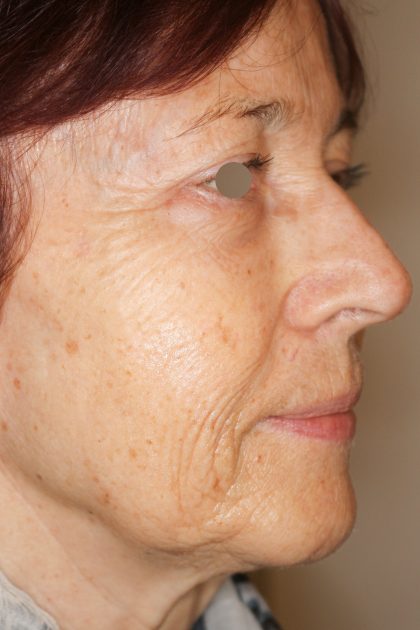 Hautunterspritzungen Before & After Patient #1394