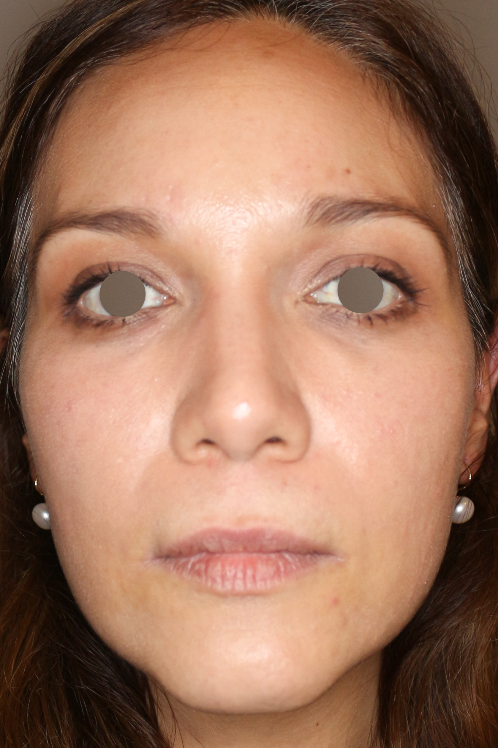 Hautunterspritzungen Before & After Patient #1391