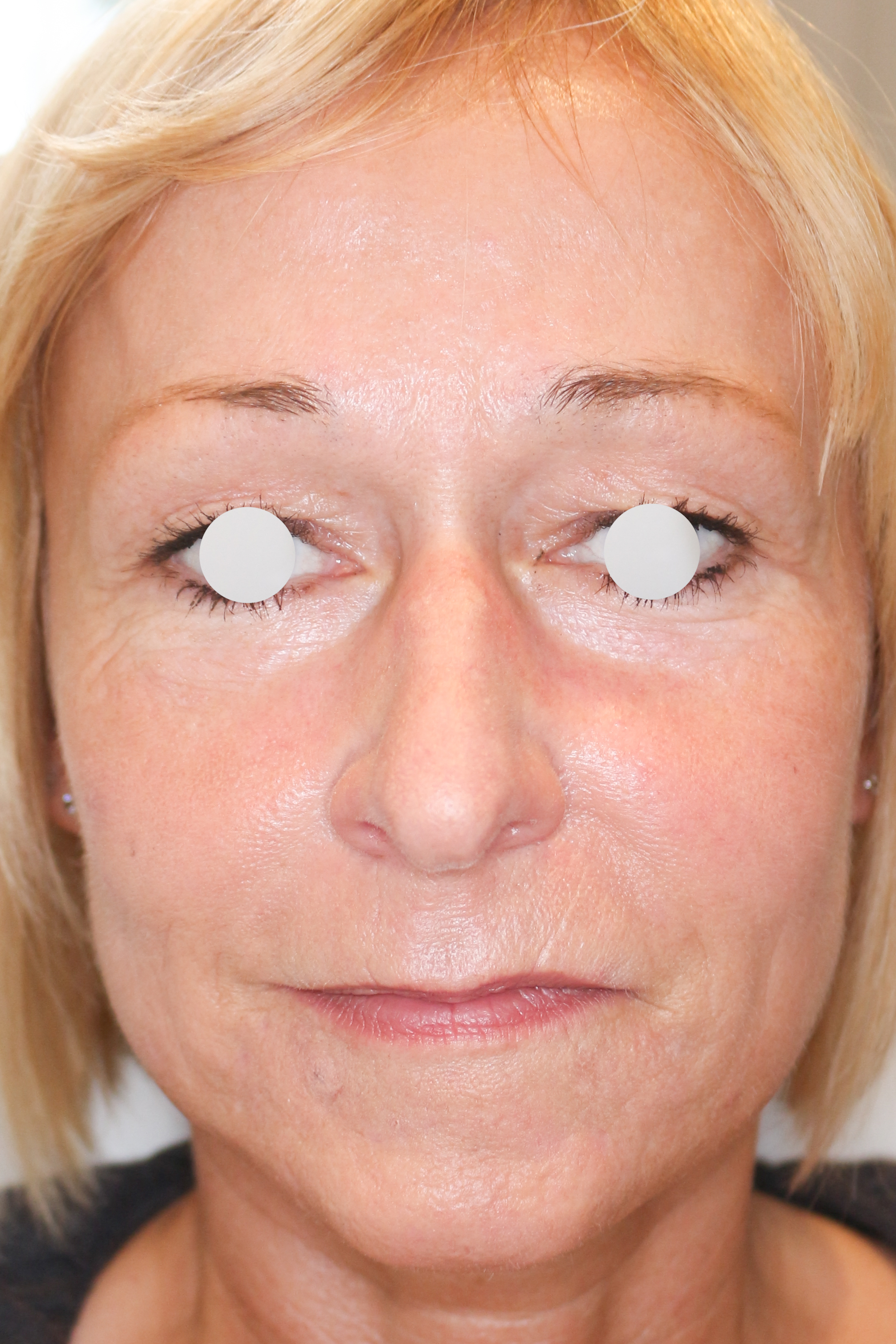 Hautunterspritzungen Before & After Patient #1388
