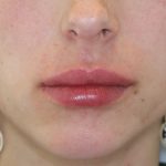 Lippenmodellierung Before & After Patient #1433