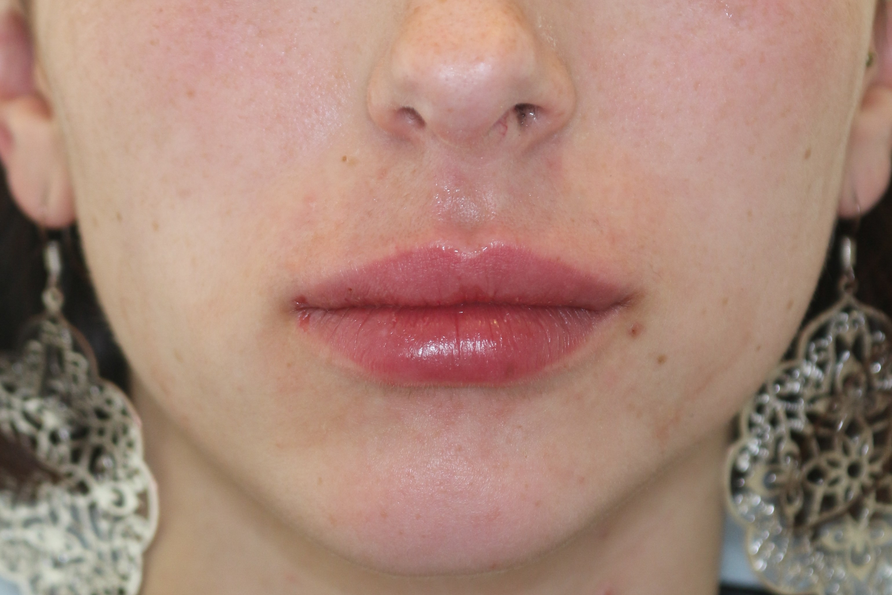 Lippenmodellierung Before & After Patient #1433