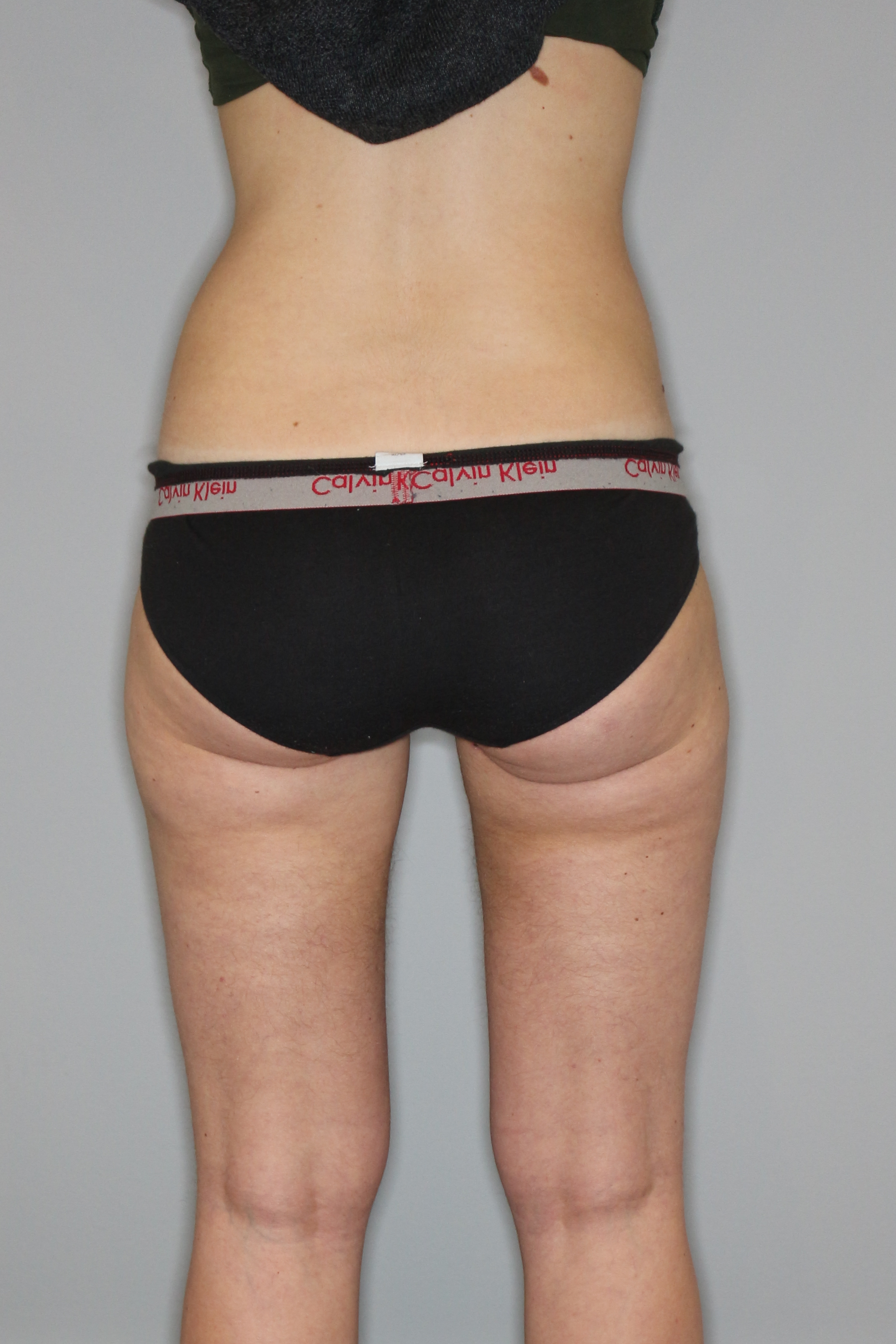 Fettabsaugung Before & After Patient #1509