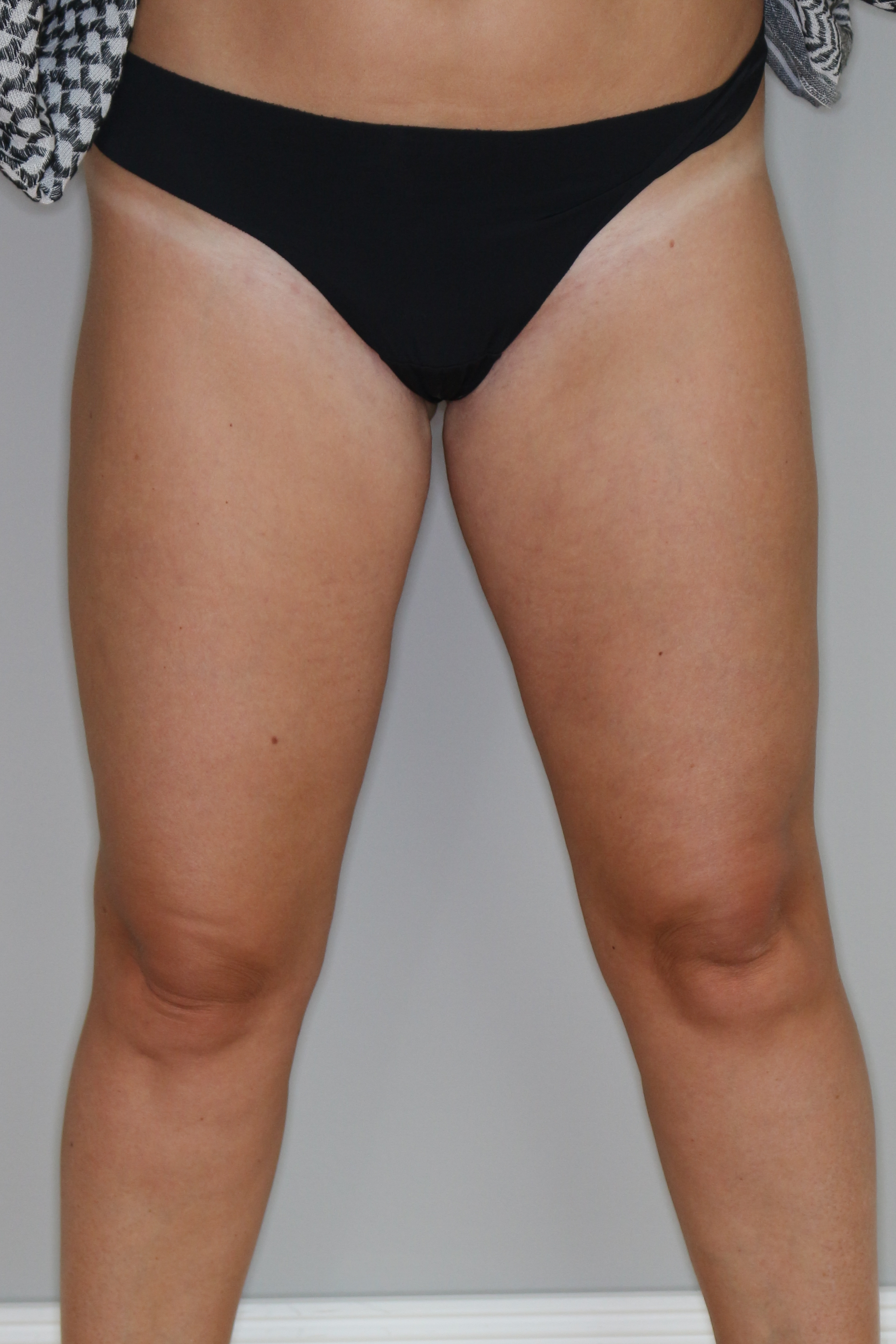 Fettabsaugung Before & After Patient #1503
