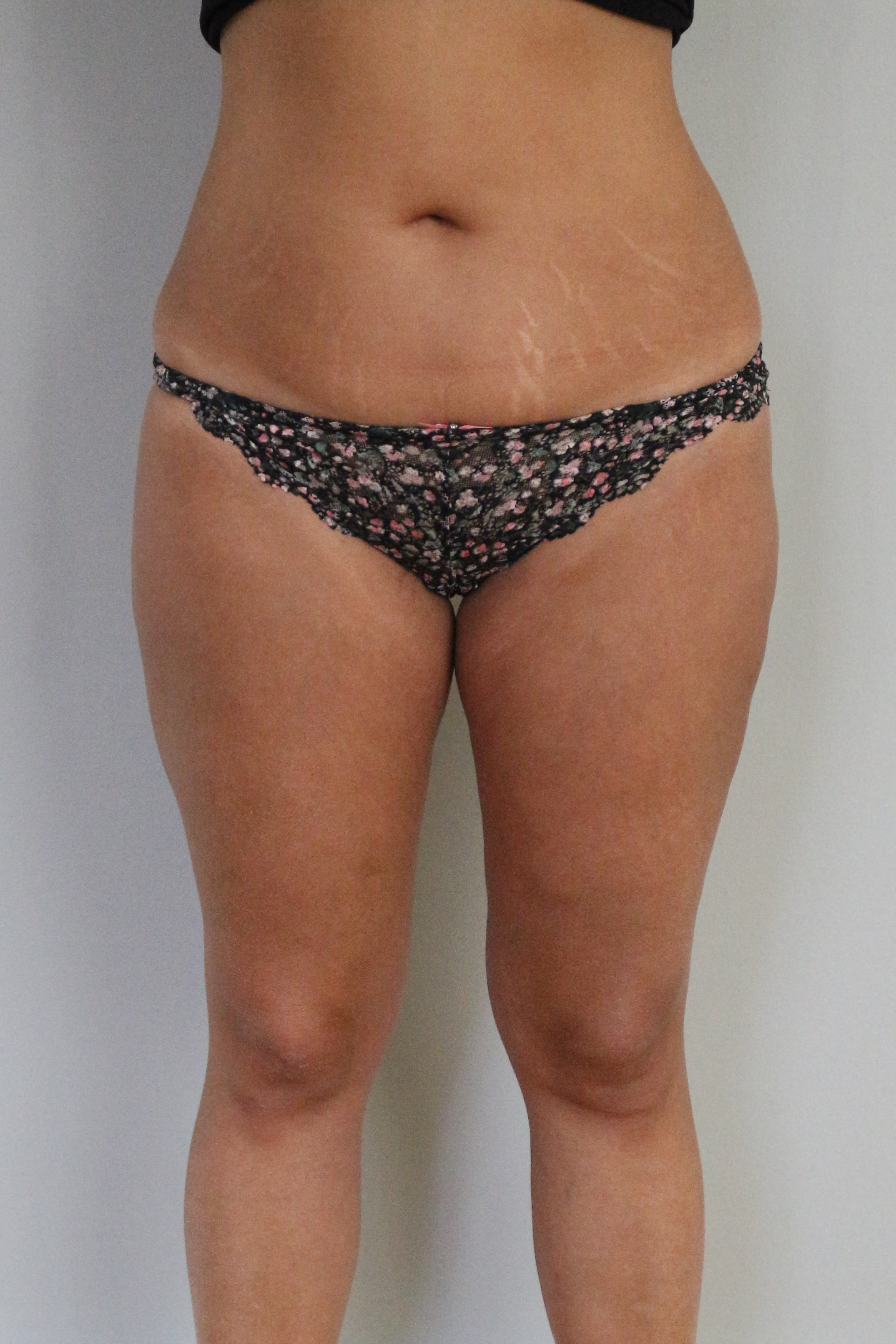 Fettabsaugung Before & After Patient #1482