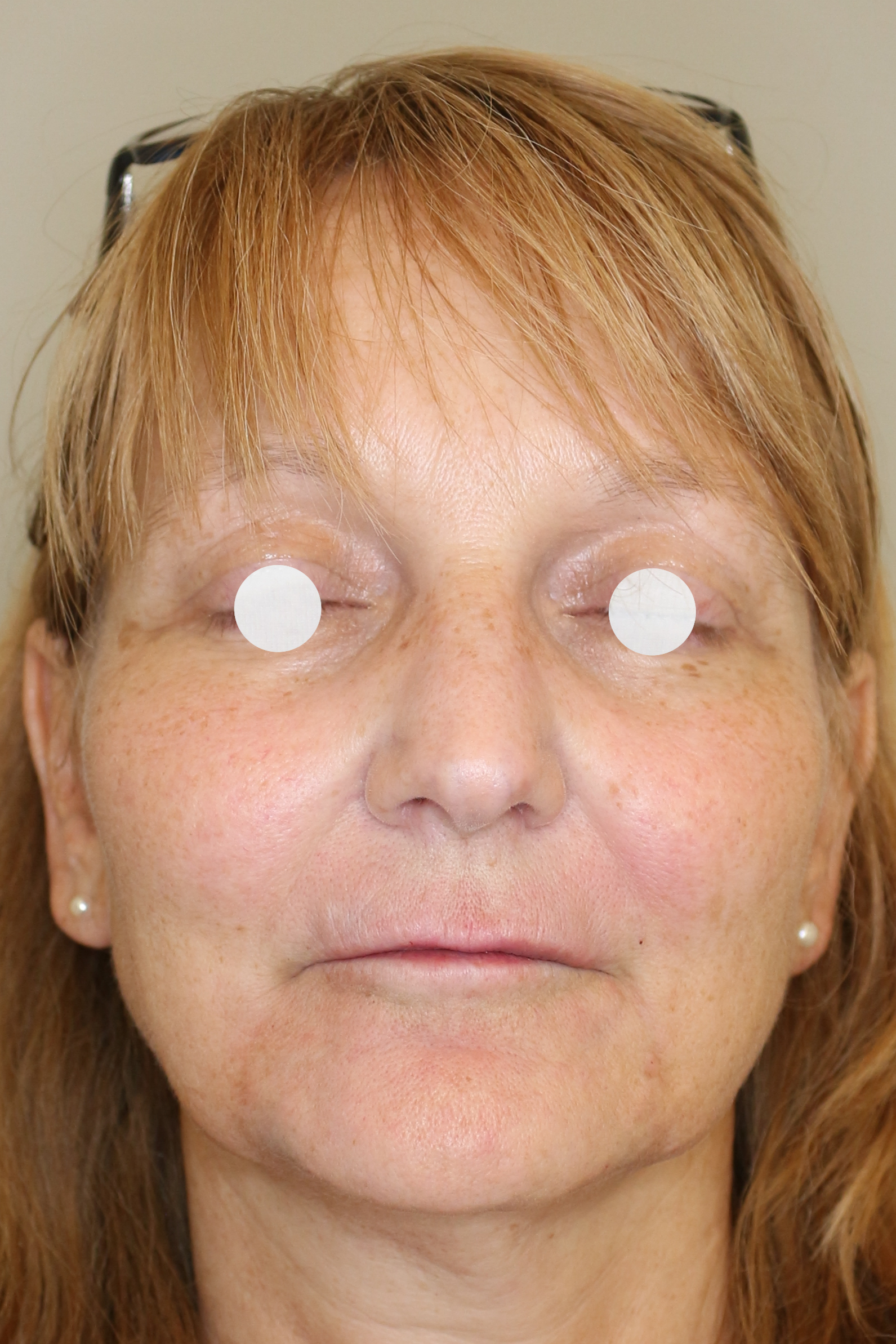 Faltenbehandlung Before & After Patient #1473