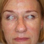 Augenlid- und Wangenmodellierung Before & After Patient #1449