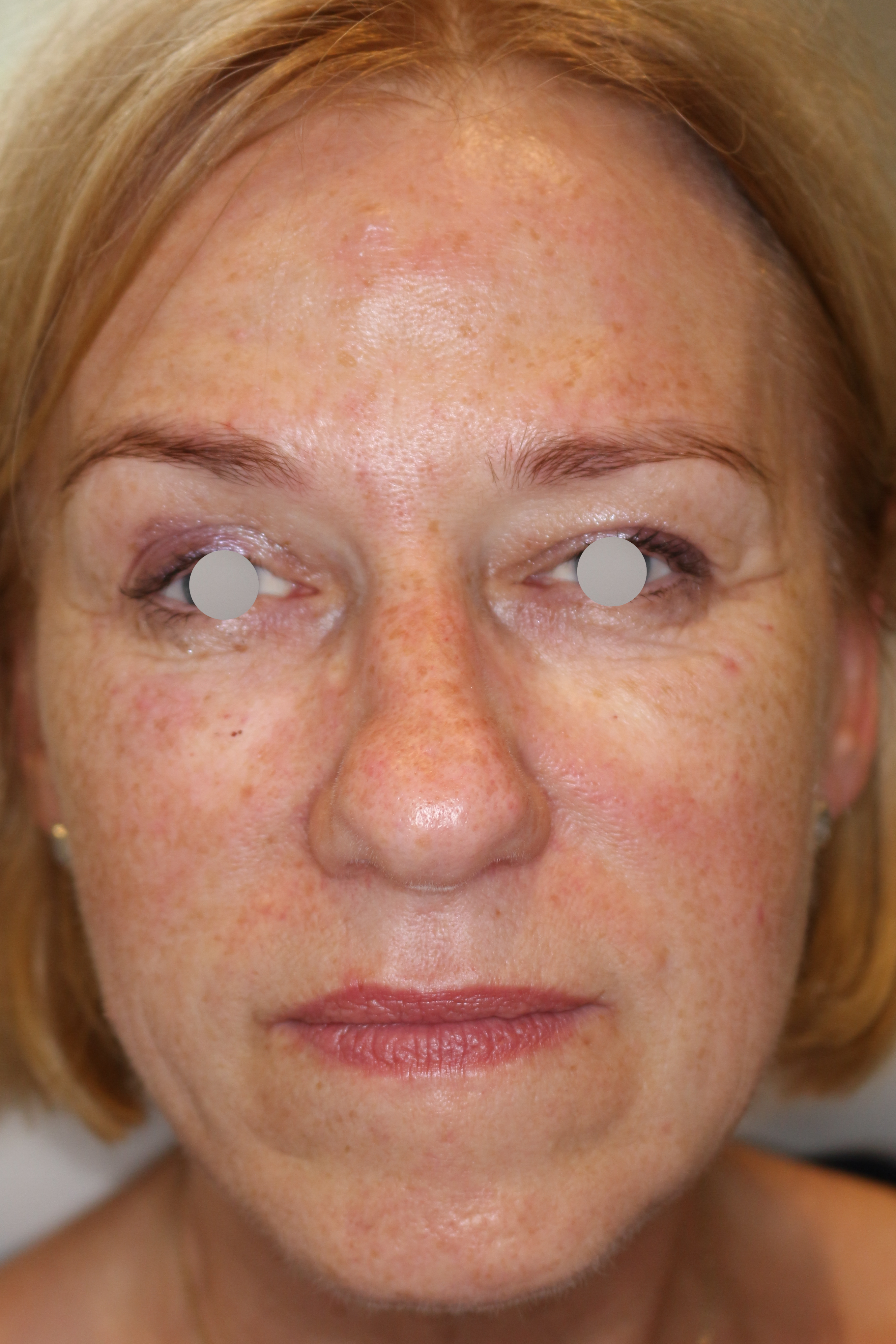 Augenlid- und Wangenmodellierung Before & After Patient #1449