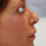 Augenlid- und Wangenmodellierung Before & After Patient #1464