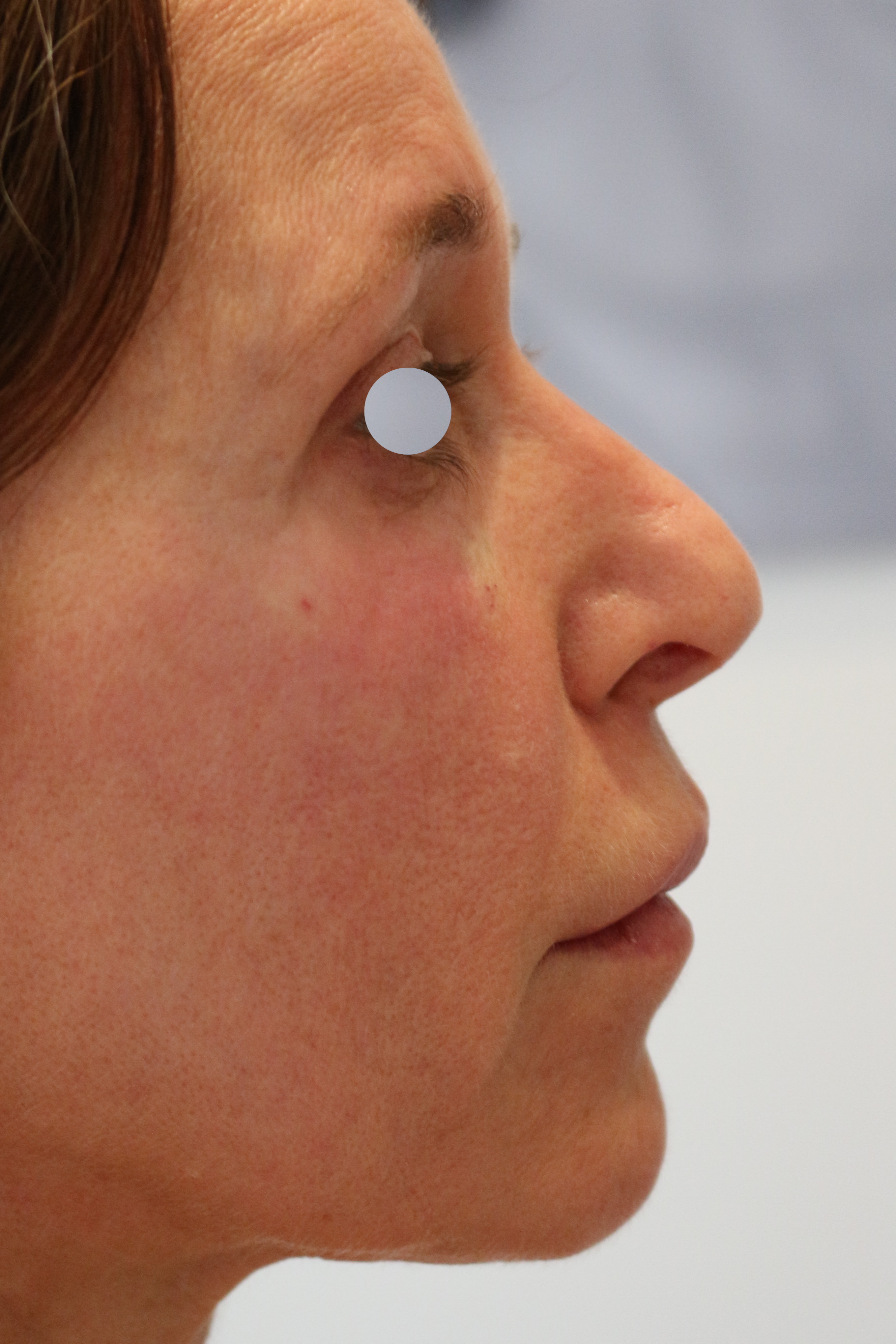 Augenlid- und Wangenmodellierung Before & After Patient #1464