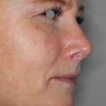 Augenlid- und Wangenmodellierung Before & After Patient #1446