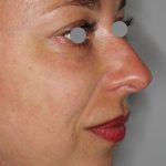 Augenlid- und Wangenmodellierung Before & After Patient #1442